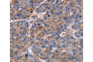 Immunohistochemistry of Human liver cancer using NPM3 Polyclonal Antibody at dilution of 1:60 (NPM3 antibody)