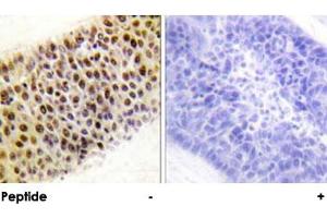 Immunohistochemical analysis of paraffin-embedded human liver carcinoma tissue using KAT5 polyclonal antibody . (KAT5 antibody)