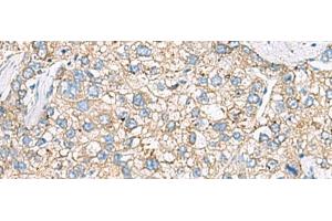 Immunohistochemistry of paraffin-embedded Human liver cancer tissue using SHC3 Polyclonal Antibody at dilution of 1:40(x200)