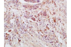 Formalin-fixed and paraffin embedded human lung carcinoma tissue labeled with Anti-FAM135B Polyclonal Antibody, Unconjugated (ABIN1386912) at 1:200 followed by conjugation to the secondary antibody and DAB staining.