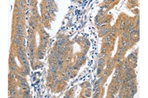 The image on the left is immunohistochemistry of paraffin-embedded Human colon cancer tissue using ABIN7128903(CENPC Antibody) at dilution 1/70, on the right is treated with fusion protein. (Centromere Protein C Pseudogene 1 (CENPCP1) antibody)