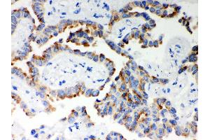 Anti- ITPR3 Picoband antibody, IHC(P) IHC(P): Human Lung Cancer Tissue (ITPR3 antibody  (N-Term))