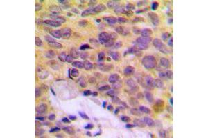 Immunohistochemical analysis of MRPL16 staining in human breast cancer formalin fixed paraffin embedded tissue section. (MRPL16 antibody  (C-Term))