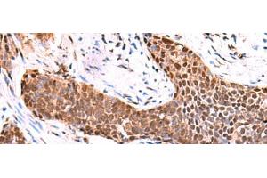Immunohistochemistry of paraffin-embedded Human esophagus cancer tissue using TSEN2 Polyclonal Antibody at dilution of 1:80(x200)