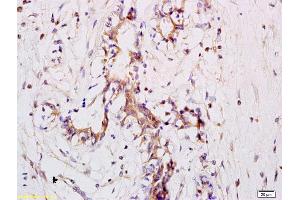 Formalin-fixed and paraffin embedded human breast carcinoma labeled with Anti CD11a Polyclonal Antibody, Unconjugated (ABIN734678) at 1:200 followed by conjugation to the secondary antibody and DAB staining (ITGAL antibody  (AA 251-350))