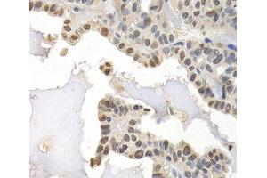 Immunohistochemistry of paraffin-embedded Human thyroid cancer using GTF2F1 Polyclonal Antibody at dilution of 1:200 (40x lens). (GTF2F1 antibody)