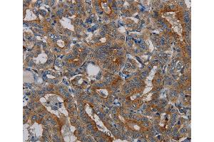 Immunohistochemistry of Human lung cancer using PER2 Polyclonal Antibody at dilution of 1:50