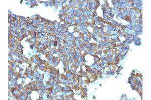 Formalin-fixed, paraffin-embedded human Ovarian Carcinoma stained with CD99 Monoclonal Antibody (MIC2/877). (CD99 antibody)