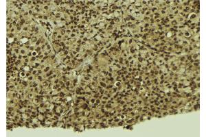 ABIN6272432 at 1/100 staining Human breast cancer tissue by IHC-P. (Sp3/4 antibody)