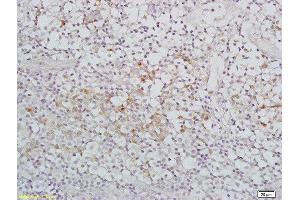 Formalin-fixed and paraffin embedded human nasopharyngeal carcinoma labeled with Rabbit Anti-IGFBP7 Polyclonal Antibody, Unconjugated  at 1:200 followed by conjugation to the secondary antibody and DAB staining (IGFBP7 antibody  (AA 131-230))