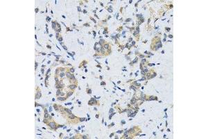 Immunohistochemistry of paraffin-embedded human gastric cancer using SLC2A13 antibody. (SLC2A13 antibody  (AA 564-648))