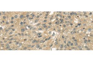 Immunohistochemistry of paraffin-embedded Human breast cancer tissue using UGT2B4 Polyclonal Antibody at dilution 1:45 (UGT2B4 antibody)