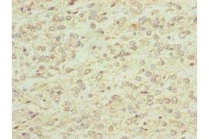 Immunohistochemistry of paraffin-embedded human glioma using ABIN7151143 at dilution of 1:100