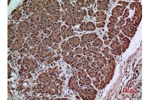 Immunohistochemistry (IHC) analysis of paraffin-embedded Human Pancreas Cancer, antibody was diluted at 1:100.