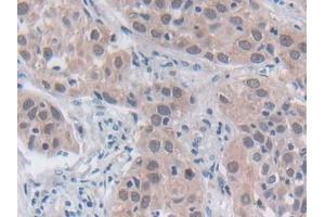 Detection of SRY in Human Lung cancer Tissue using Polyclonal Antibody to Sex Determining Region Y (SRY) (SRY antibody  (AA 1-204))