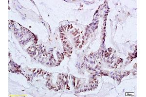 Formalin-fixed and paraffin embedded human colon carcinoma labeled with Anti-Ack1 Polyclonal Antibody, Unconjugated (ABIN673659) at 1:200 followed by conjugation to the secondary antibody and DAB staining. (TNK2 antibody  (AA 301-420))