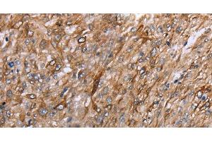 Immunohistochemistry of paraffin-embedded Human esophagus cancer using GRPR Polyclonal Antibody at dilution of 1:40 (GRPR antibody)