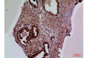 Immunohistochemistry (IHC) analysis of paraffin-embedded Human Prostate Cancer, antibody was diluted at 1:100.