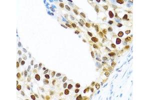 Immunohistochemistry of paraffin-embedded Human prostate cancer using KHDRBS2 Polyclonal Antibody at dilution of 1:100 (40x lens). (KHDRBS2 antibody)