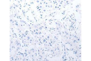 Immunohistochemistry (IHC) image for anti-Matrix Metallopeptidase 11 (Stromelysin 3) (MMP11) antibody (ABIN1873715) (MMP11 antibody)