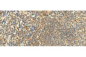 Immunohistochemistry of paraffin-embedded Human tonsil tissue using CLEC4D Polyclonal Antibody at dilution of 1:50(x200) (CLEC4D antibody)
