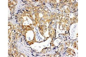 IHC-P: SDHC antibody testing of human gastric cancer tissue