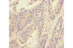 Immunohistochemistry of paraffin-embedded human colon cancer using ABIN7170628 at dilution of 1:100 (RBM17 antibody  (AA 1-240))