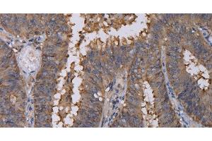 Immunohistochemistry of paraffin-embedded Human colon cancer using REG3G Polyclonal Antibody at dilution of 1:40 (REG3g antibody)
