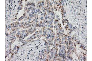Immunohistochemical staining of paraffin-embedded Carcinoma of Human lung tissue using anti-HOXC11 mouse monoclonal antibody. (HOXC11 antibody)