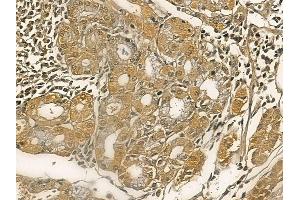 GUCA1A Mouse Monoclonal Antibody at 1/100 staining human ovarian cancer by IHC-P.
