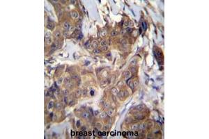 ATP6V1B1 Antibody (C-term) immunohistochemistry analysis in formalin fixed and paraffin embedded human breast carcinoma followed by peroxidase conjugation of the secondary antibody and DAB staining. (ATP6V1B1 antibody  (C-Term))