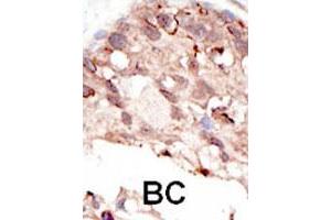 Formalin-fixed and paraffin-embedded human cancer tissue reacted with the SUV39H2 polyclonal antibody  , which was peroxidase-conjugated to the secondary antibody, followed by DAB staining.