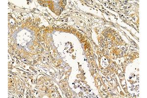 ABIN7093122 and ABIN7098213 at 1/100 staining human gastric cancer by IHC-P. (DLEU1 antibody  (C-Term))