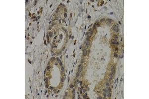 Immunohistochemistry of paraffin-embedded human stomach cancer using MAGEA1 antibody (ABIN5973183) at dilution of 1/200 (40x lens). (MAGEA1 antibody)