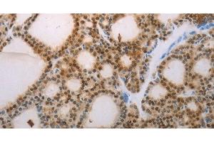 Immunohistochemistry of paraffin-embedded Human thyroid cancer tissue using S100A1 Polyclonal Antibody at dilution 1:70 (S100A1 antibody)