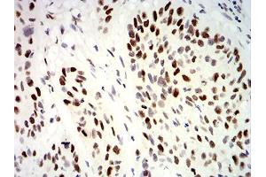 Immunohistochemical analysis of paraffin-embedded esophageal cancer tissues using UHRF1 mouse mAb with DAB staining. (UHRF1 antibody  (AA 616-755))