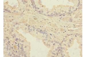 Immunohistochemistry of paraffin-embedded human prostate cancer using ABIN7171878 at dilution of 1:100 (TSPAN4 antibody  (AA 107-201))