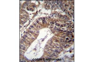 GCC1 Antibody (C-term) (ABIN656908 and ABIN2846105) immunohistochemistry analysis in formalin fixed and paraffin embedded human colon carcinoma followed by peroxidase conjugation of the secondary antibody and DAB staining.