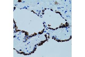 Immunohistochemistry of paraffin-embedded human lung using Cathepsin E (CTSE) antibody (ABIN3016440, ABIN3016441, ABIN3016442 and ABIN6219747) at dilution of 1:100 (40x lens). (Cathepsin E antibody)