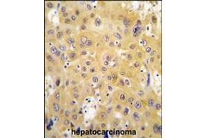 Formalin-fixed and paraffin-embedded human hepatocarcinoma tissue reacted with ECGF1 antibody , which was peroxidase-conjugated to the secondary antibody, followed by DAB staining. (Thymidine Phosphorylase antibody  (AA 318-345))