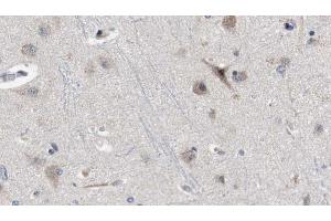ABIN6272329 at 1/100 staining Human brain cancer tissue by IHC-P. (IL1RAPL2 antibody  (Internal Region))