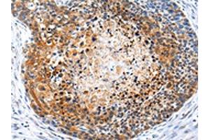 The image on the left is immunohistochemistry of paraffin-embedded Human esophagus cancer tissue using ABIN7193097(ZFP30 Antibody) at dilution 1/25, on the right is treated with synthetic peptide. (Zinc Finger Protein 3 Homolog (ZFP3) antibody)