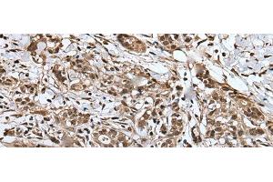 Immunohistochemistry of paraffin-embedded Human gastric cancer tissue using UPK3A Polyclonal Antibody at dilution of 1:30(x200) (Uroplakin 3A antibody)