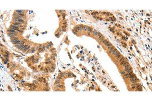 Immunohistochemistry of paraffin-embedded Human colon cancer tissue using HTR3A Polyclonal Antibody at dilution 1:50 (Serotonin Receptor 3A antibody)