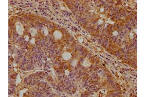 IHC image of ABIN7169092 diluted at 1:300 and staining in paraffin-embedded human pancreatic cancer performed on a Leica BondTM system. (NEK1 antibody  (AA 1-104))