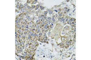 Immunohistochemistry of paraffin-embedded human lung cancer using VEPH1 antibody (ABIN5974616) (40x lens). (VEPH1 antibody)