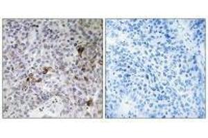 Immunohistochemistry analysis of paraffin-embedded human lung carcinoma tissue using RAB11FIP3 antibody. (RAB11FIP3 antibody  (C-Term))