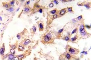 Immunohistochemistry (IHC) analyzes of p-eIF4E in paraffin-embedded human breast carcinoma tissue. (EIF4E antibody  (pSer209))