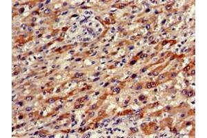 Immunohistochemistry of paraffin-embedded human liver cancer using ABIN7161673 at dilution of 1:100 (Olfactomedin 1 antibody  (AA 374-441))