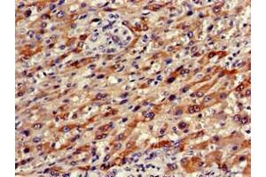 Immunohistochemistry of paraffin-embedded human liver cancer using ABIN7161673 at dilution of 1:100